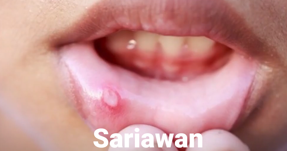 Ciri Gejala Sariawan HIV Yang Mudah Dilihat