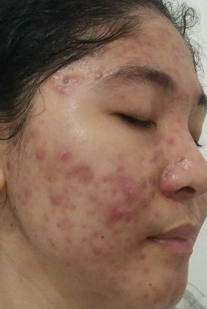 My Acne Story With Cuka Apel OrganicBeaute