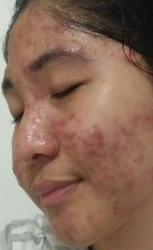 My Acne Story With Cuka Apel OrganicBeaute