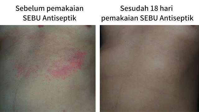 Akibat Ganti Pasangan Mandi, Sabun SEBU Bantu Mengatasi