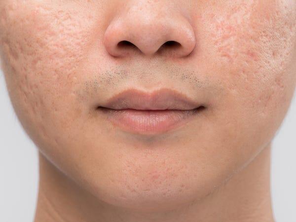 WAJIB TAHU! Inilah 5 Jenis Bekas Jerawat &amp; Cara Mengatasinya.