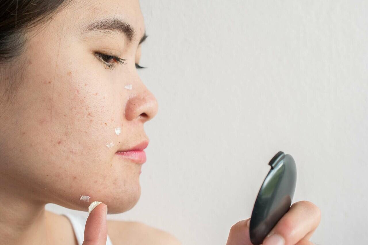 SERING DIALAMI KULIT SENSITIF, IniLAH 5 Fakta PURGING.