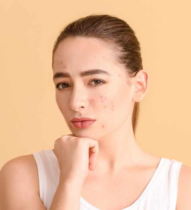 SERING DIALAMI KULIT SENSITIF, IniLAH 5 Fakta PURGING.