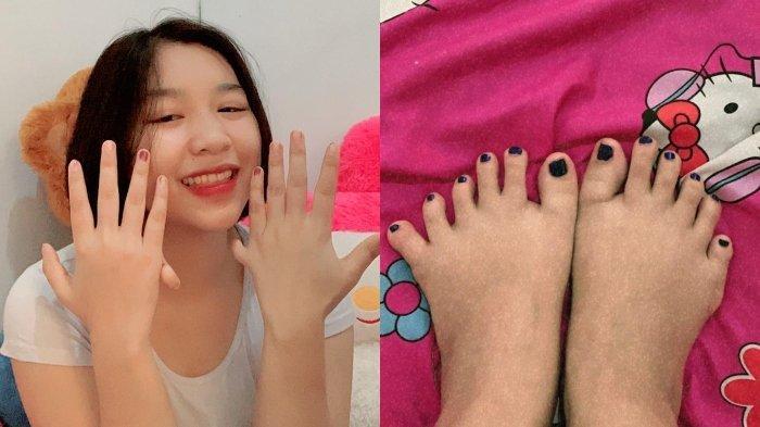 Viral Gadis pengidap Polidaktili yang memiliki 24 Jari
