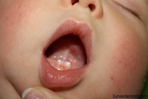 Natal Teeth, Fenomena Unik Bayi Tumbuh Gigi Sejak Baru Lahir! Bukan Mistis