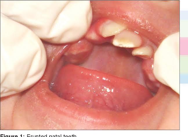 Natal Teeth, Fenomena Unik Bayi Tumbuh Gigi Sejak Baru Lahir! Bukan Mistis