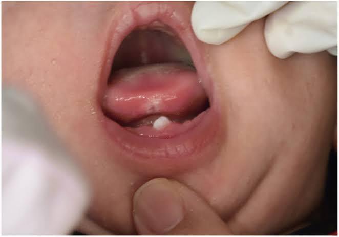 Natal Teeth, Fenomena Unik Bayi Tumbuh Gigi Sejak Baru Lahir! Bukan Mistis