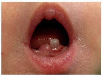 Natal Teeth, Fenomena Unik Bayi Tumbuh Gigi Sejak Baru Lahir! Bukan Mistis