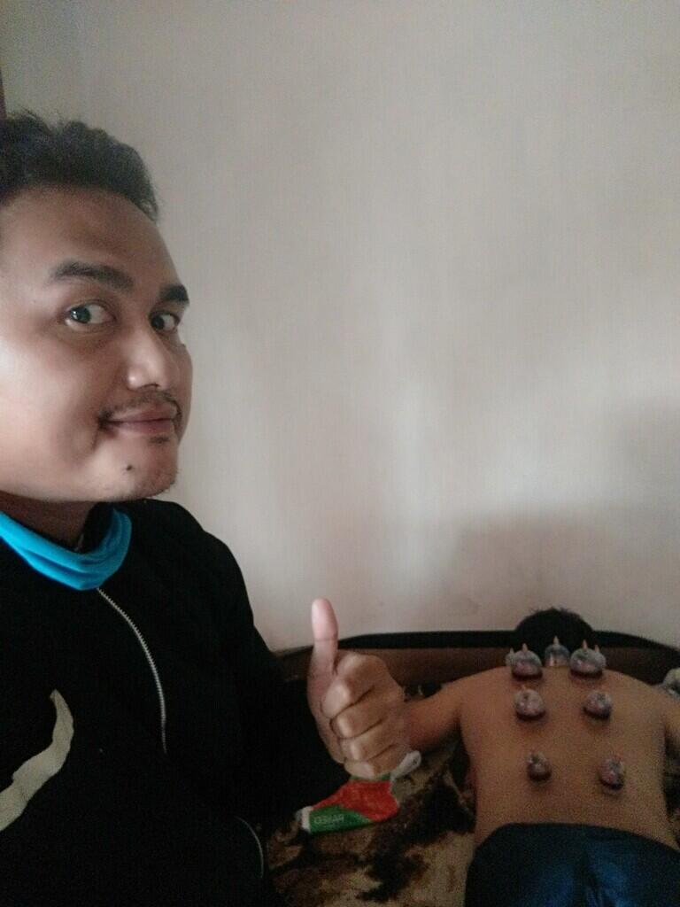 Pengalaman pertama tertusuk jarum bekam