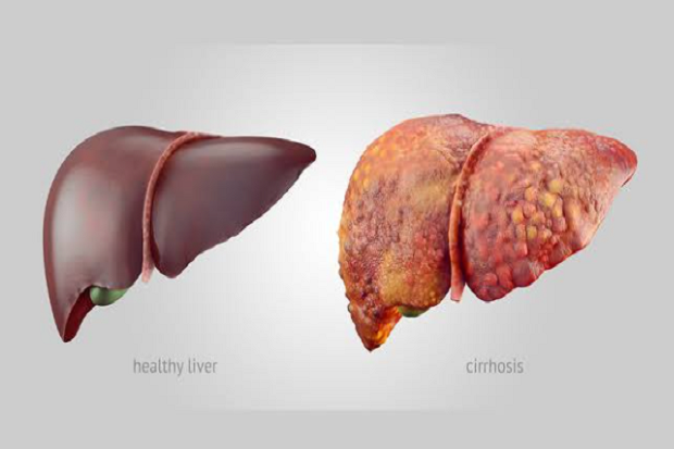 Jaga Kesehatan Organ Hati, Lakukan Deteksi Dini dan Kenali Gejalanya