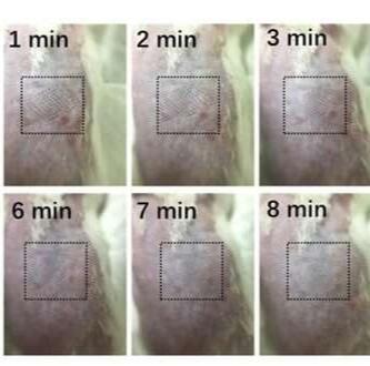 Alat Penyelamat Hidup Pasien Kanker, Dengan Metode Teknologi Microneedles