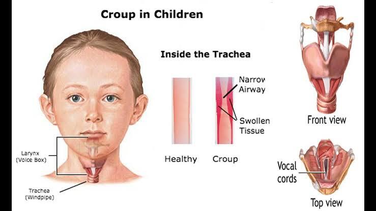 Croup, Gangguan Pernafasan Pada Anak yang Akibatkan Penderitanya Batuk Menggonggong