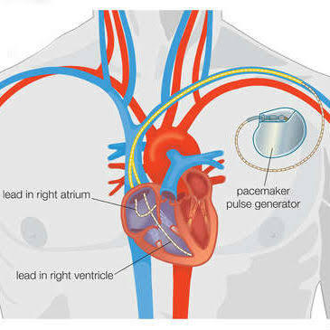 Kenali ICD, Alat Bantu Jantung yang akan Dipasangkan pada Tubuh Eriksen