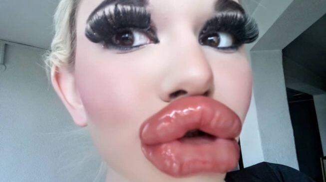 Ingin Seperti Barbie, Wanita Ini Perbesar Bibir Hingga Ukurannya Tak Wajar