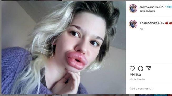 Ingin Seperti Barbie, Wanita Ini Perbesar Bibir Hingga Ukurannya Tak Wajar