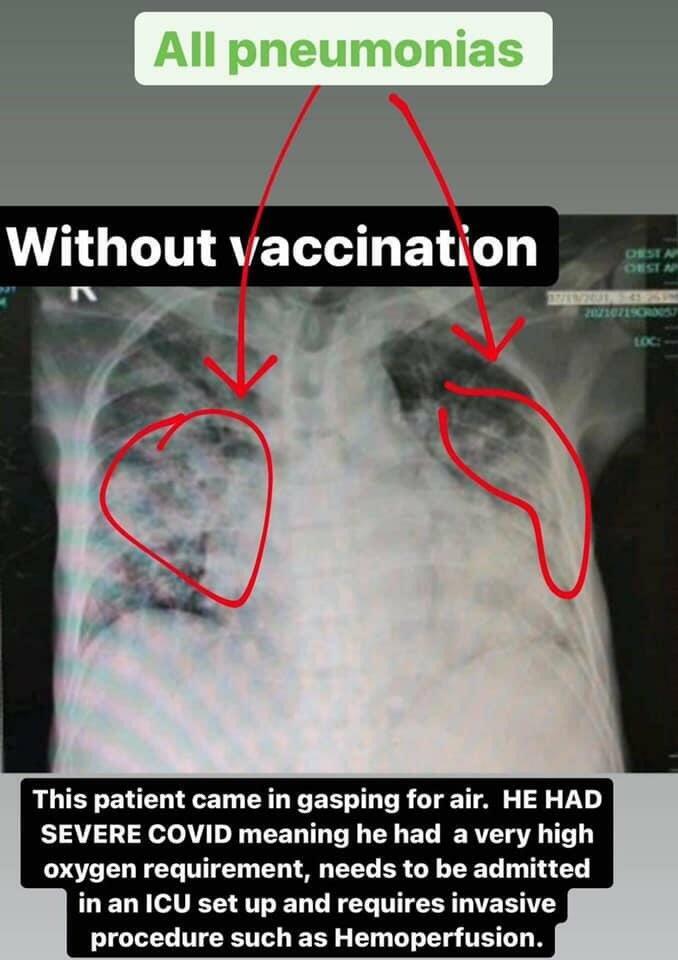 Viral Perbandingan Paru-paru Pasien COVID-19, Divaksin Vs Tidak Divaksin