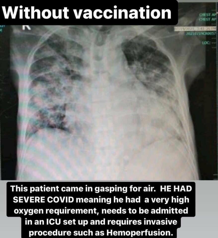 Viral Perbandingan Paru-paru Pasien COVID-19, Divaksin Vs Tidak Divaksin