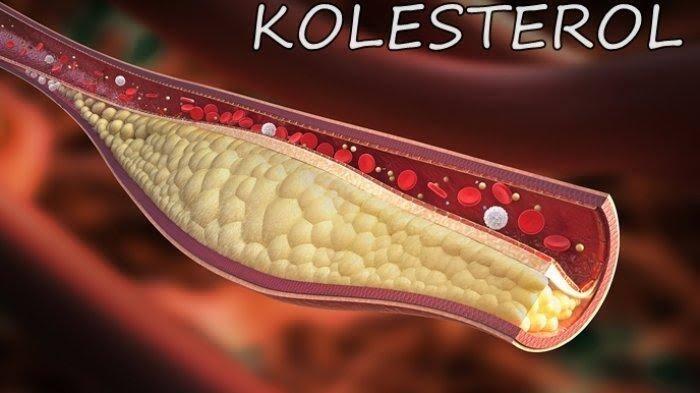 Kolesterol dan Efeknya Terhadap Pria dan Wanita