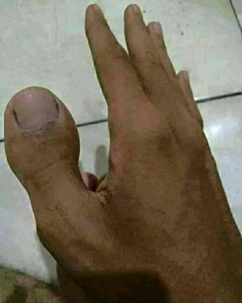 Kenali Gejala Peregangan Tangan Kebas