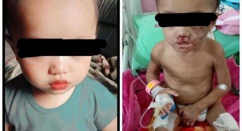 Dianiaya Calon Ayah Sambung, Bayi di Kota Batu Terluka Disiram Air Panas