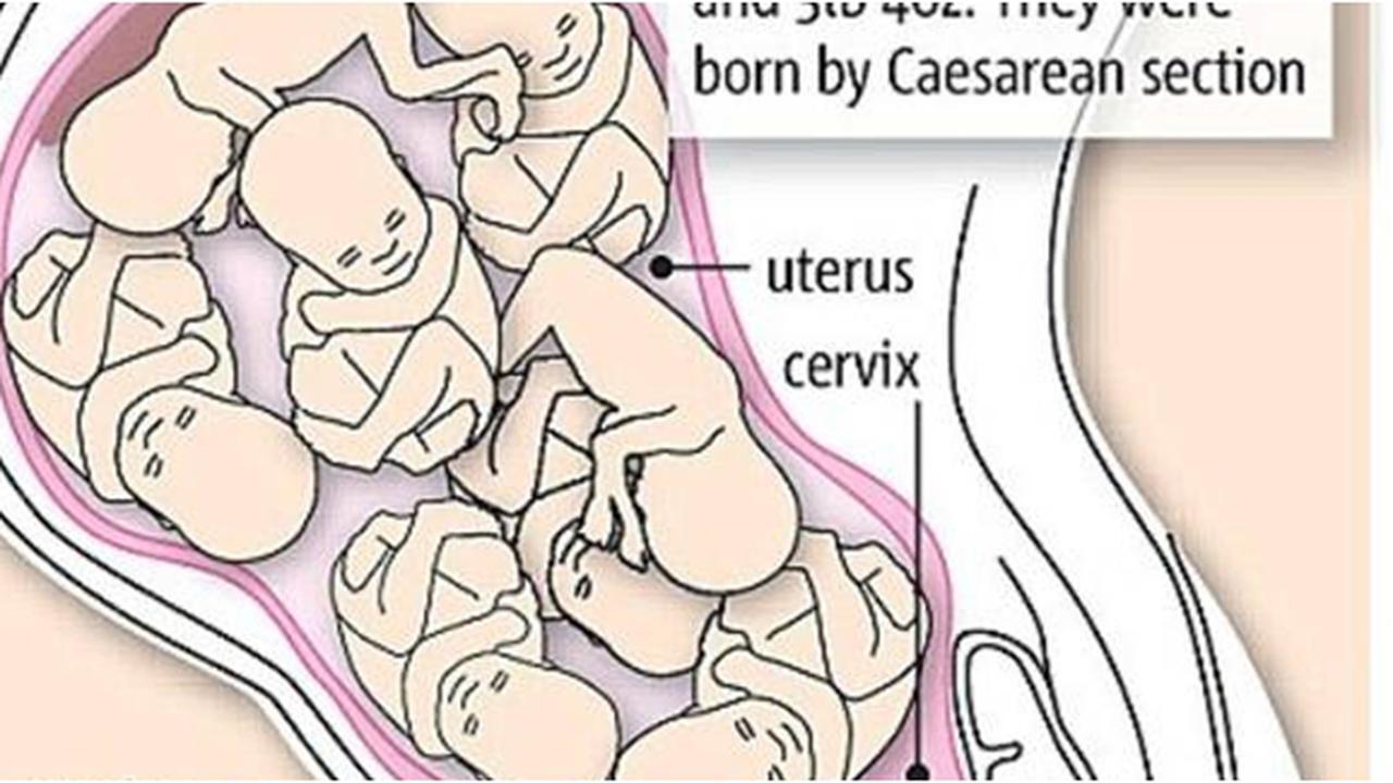 8 Kisah Kelahiran Bayi Kembar Terbanyak Di Dunia! Bisa Bikin Squad Bola Nih!