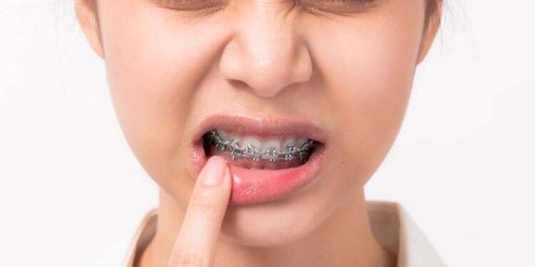 Stop.! Mengelupas Kulit Mati Pada Bibir, Bisa Memicu Tumor Loh!