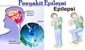 Penyebab Penyakit Epilepsi, Yang Tidak Bisa Disembuhkan!