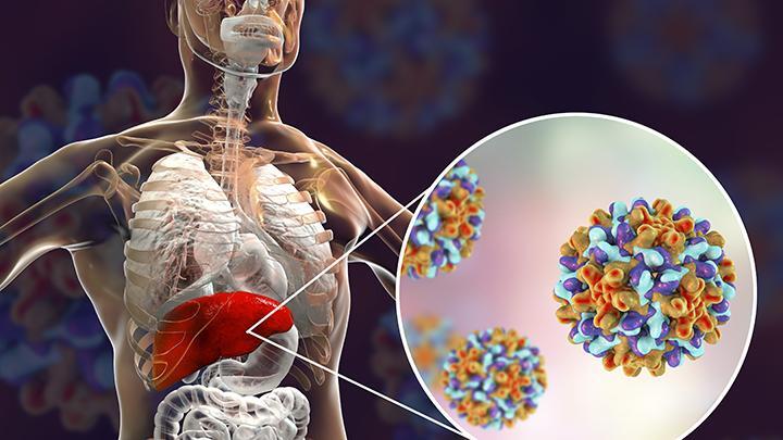 Kasus Hepatitis Akut di Indonesia, Kemenkes: 5 Meninggal, 10 Dirawat