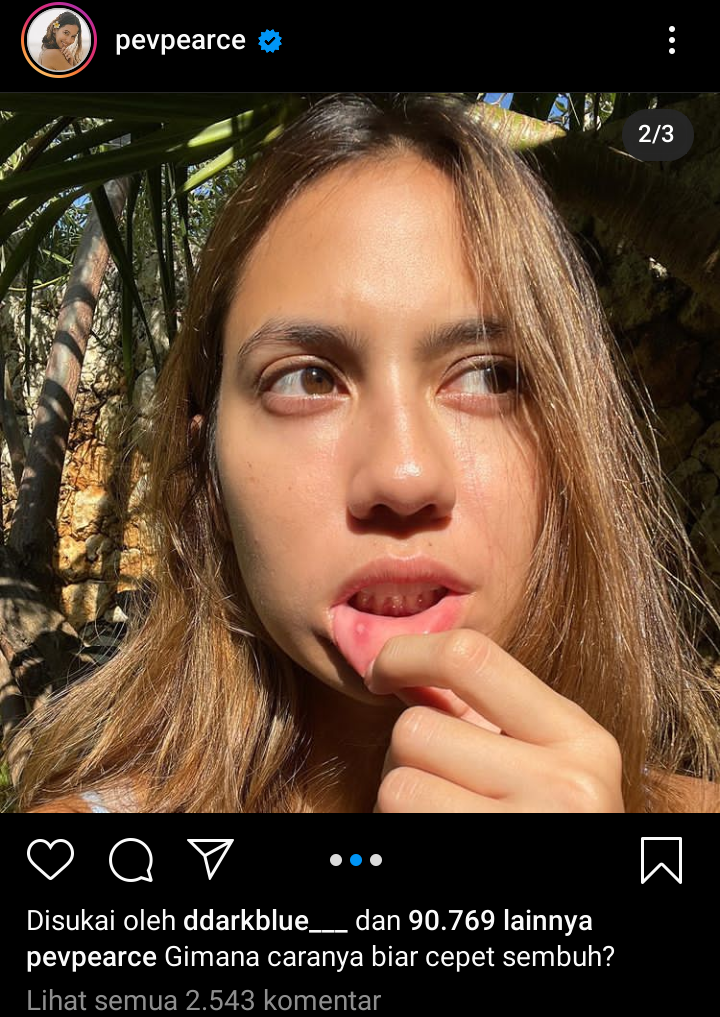 Pevita Pearce Sariawan Bikin Heboh Warganet, Gimana Kalau Agan, Tahu Obatnya?