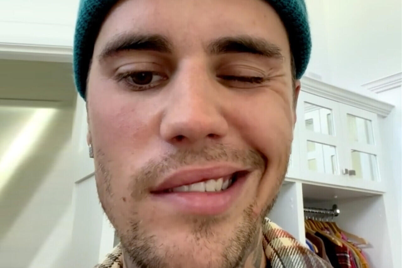 Justin Bieber mengatakan dia mengalami kelumpuhan wajah karena sindrom Ramsay Hunt
