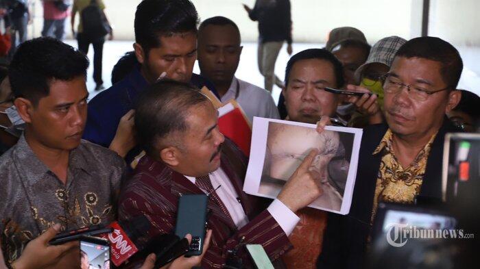 Ini 15 Bekas Luka Tubuh Brigadir J Versi Pengacara, Ada Telinga, Perut hingga Ketiak