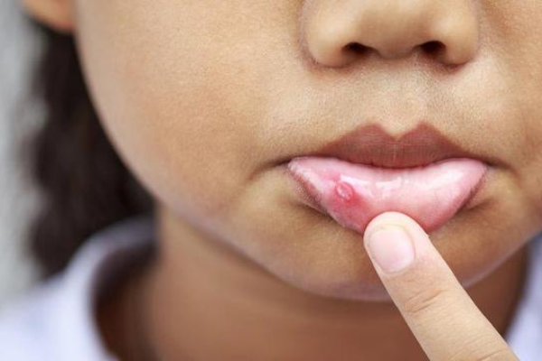 3 Penyebab Sariawan Anak Yang Bunda Harus Tahu