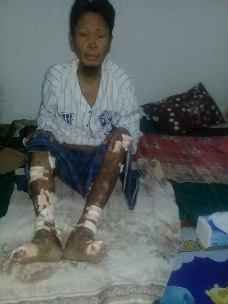 Maulana yusuf!! 90% Badannya Tersiram Minyak Panas