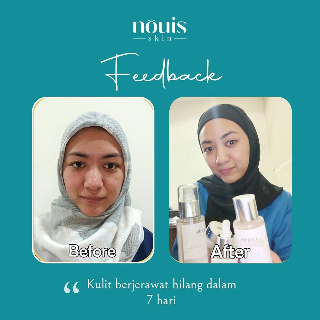 Penawaran Jadi Marketer Nouis Skincare Tanpa Syarat