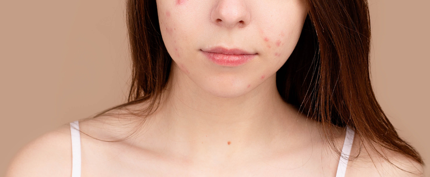 Awas! Jerawat Rentan Datang pada Usia Pubertas