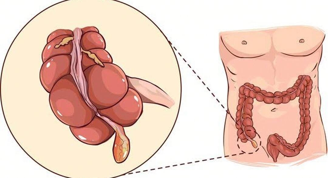 Benarkah Penyakit Usus Buntu Disebabkan Biji Cabe atau Biji Jambu Klutuk? 