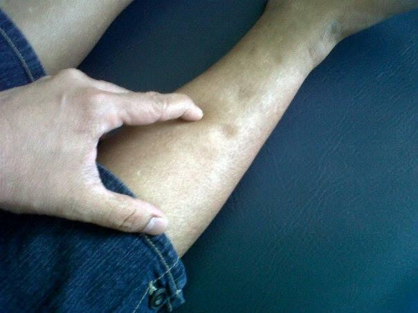 Pembengkakan Pada Area Kaki Atau Endema Pada Ibu Hamil, Gimana Cara Mengatasinya?