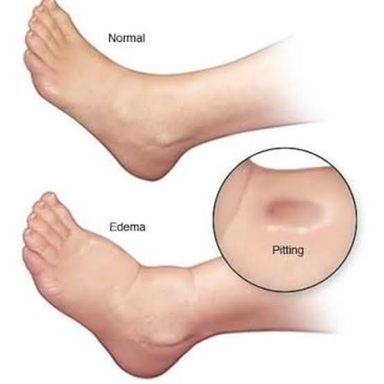 Pembengkakan Pada Area Kaki Atau Endema Pada Ibu Hamil, Gimana Cara Mengatasinya?