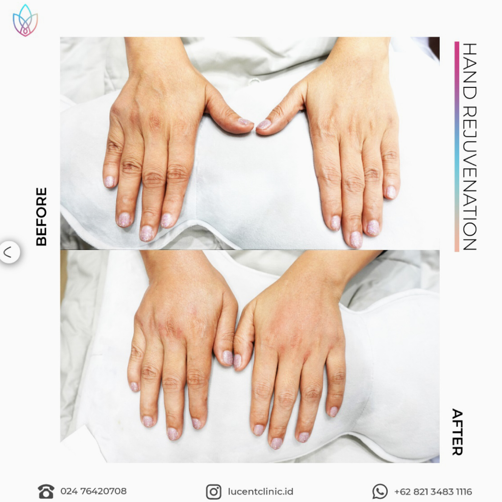 Treatment Hand Rejuvenation Terbaik di Semarang