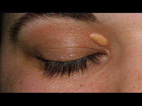 Misteri Xanthoma