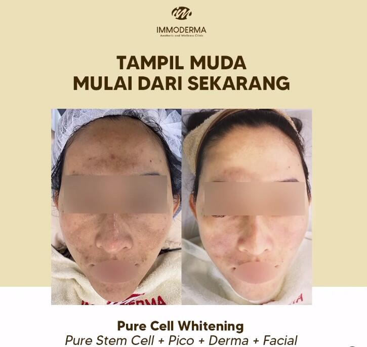 Mengatasi Tanda Penuaan Dini Pure Cell Whitening Immoderma Skin Clinic Semarang