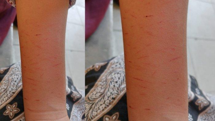 Siswa SD di Serang Sayat Tangan Bentuk 'Kode' Aneh, Berikut Hasil Temuan Dinas