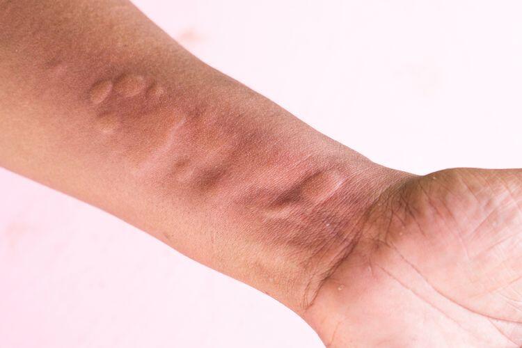 Tips Mencegah Biduran agar Tidak Kambuh Lagi ( Ada Yang Pernah Ngalamin ? )