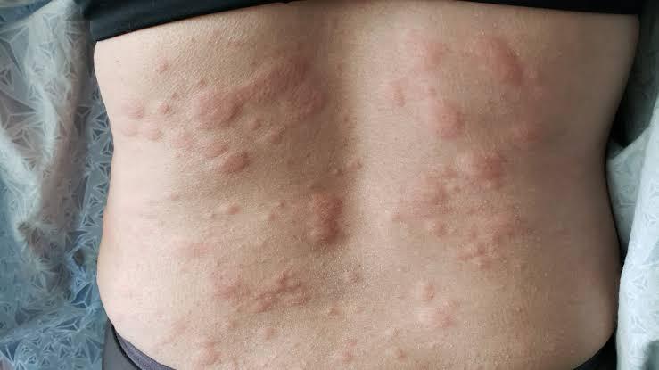 Tips Mencegah Biduran agar Tidak Kambuh Lagi ( Ada Yang Pernah Ngalamin ? )