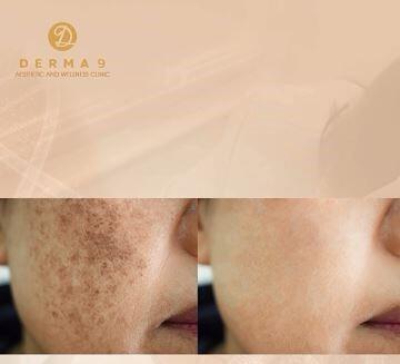 Ini Dia Ciri-Ciri Wajah yang Terkena Merkuri | KASKUS