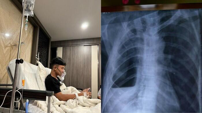 Viral! Pelajar di Klaten Jawa Tengah terkena faringitis akut akibat ngevape