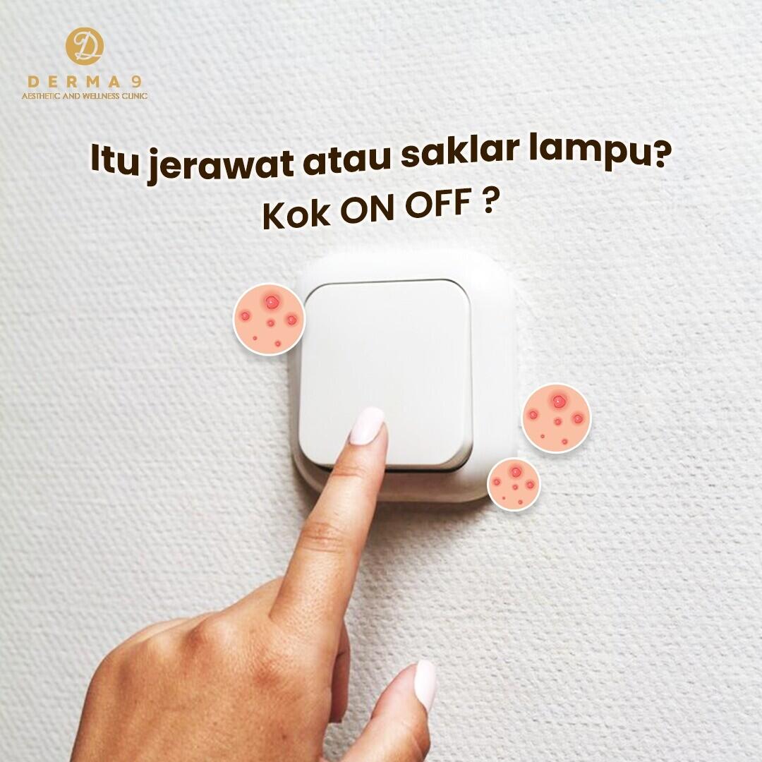 Mengatasi Permasalahan Kulit Jerawat On-Off di Derma 9 Klinik Kecantikan Solo