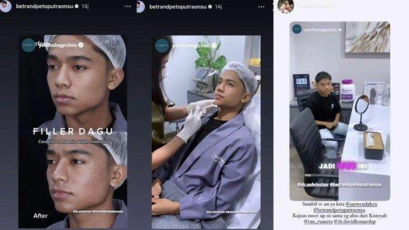 Ganteng Maksimal! Bertrand Peto Jalani Filler Dagu untuk Penampilan Terbaiknya