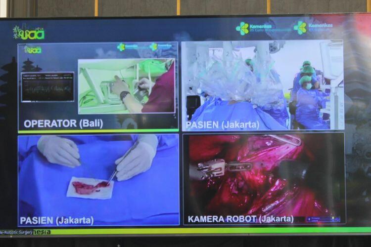Operasi Jarak Jauh Berhasil Dilakukan di Indonesia, Dokter di Bali Pasien di Jakarta!