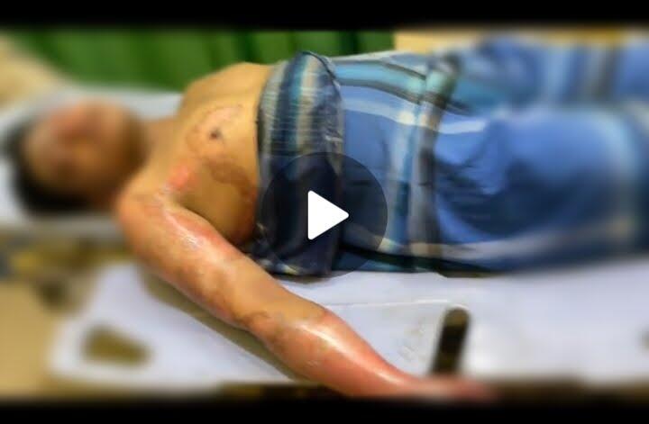 Santri Asal Aceh Tengah Diduga Dibakar, Polisi Periksa Lima Teman Korban
